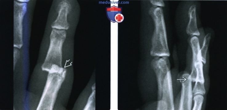 Рентгенограмма, КТ, МРТ при переломе и вывихе пальца кисти