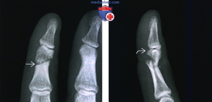 Рентгенограмма, КТ, МРТ при переломе и вывихе пальца кисти