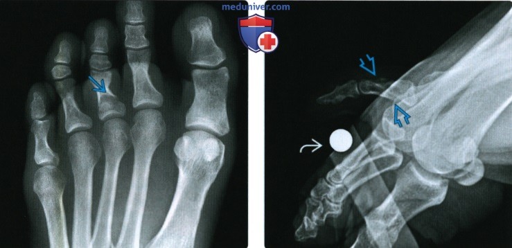 Рентгенограмма, КТ, МРТ при переломе и вывихе пальцев стопы