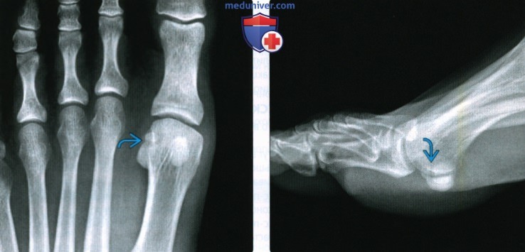 Рентгенограмма, КТ, МРТ при переломе и вывихе пальцев стопы