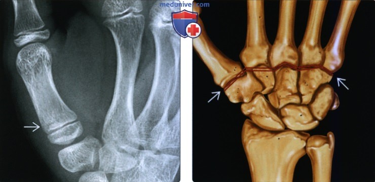 Рентгенограмма, КТ, МРТ при переломе и вывихе пястной кости