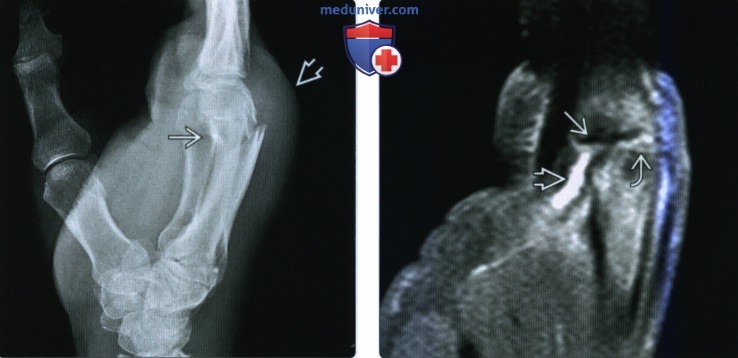 Рентгенограмма, КТ, МРТ при переломе и вывихе пястной кости