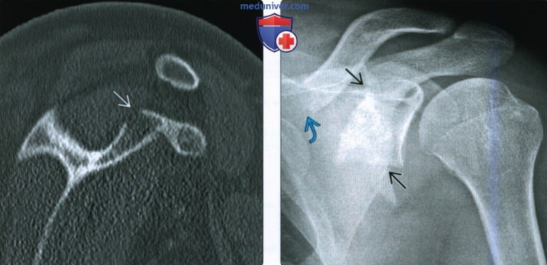 Рентгенограмма, КТ, МРТ при переломе лопатки