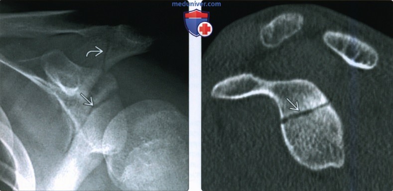 Рентгенограмма, КТ, МРТ при переломе лопатки