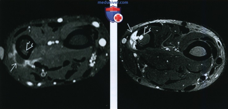 Рентгенограмма, КТ, МРТ при периостальной остеосаркоме