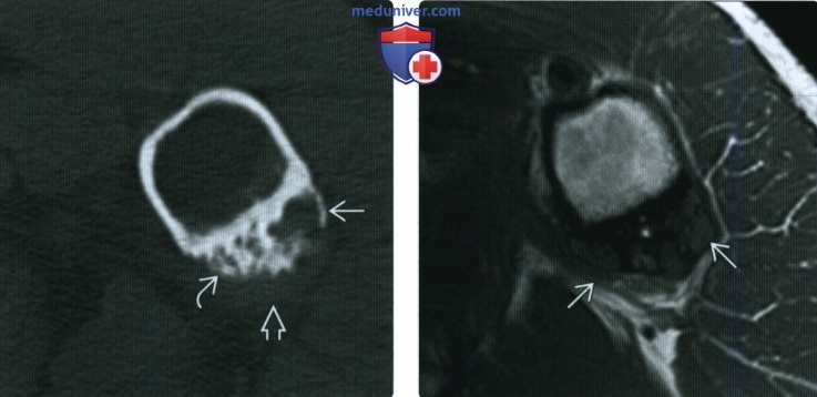 Рентгенограмма, КТ, МРТ при периостальной хондроме