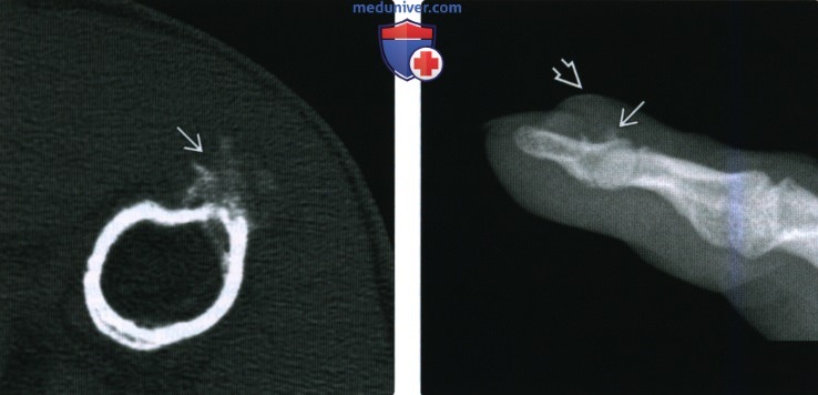 Рентгенограмма, КТ, МРТ при периостальной хондроме