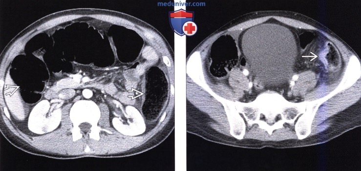 Рентгенограмма, КТ, МРТ, ПЭТ при раке толстой кишки