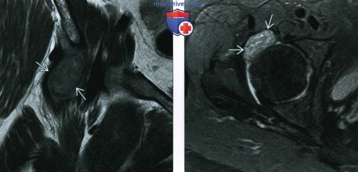 Рентгенограмма, КТ, МРТ при пирофосфатной артропатии