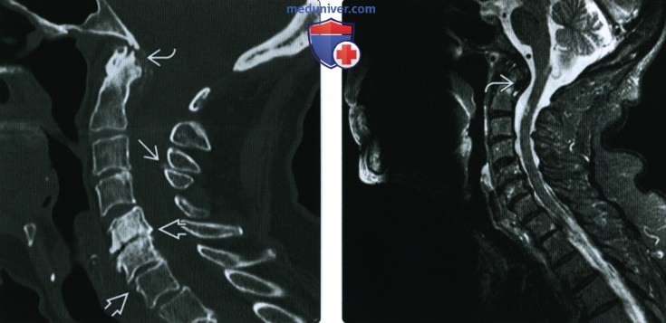 Рентгенограмма, КТ, МРТ при пирофосфатной артропатии