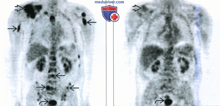 Рентгенограмма, КТ, МРТ при плазмоцитоме