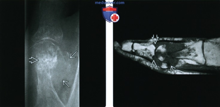 Рентгенограмма, КТ, МРТ при подагре