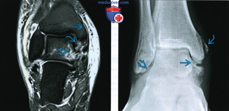 Рентгенограмма, КТ, МРТ при повреждении дельтовидной связки
