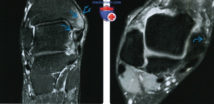 Рентгенограмма, КТ, МРТ при повреждении дельтовидной связки