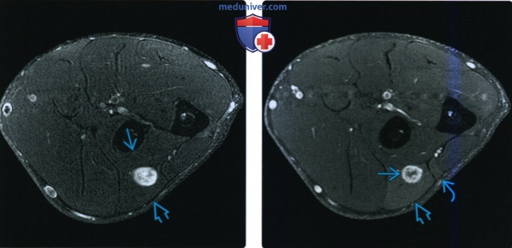Рентгенограмма, КТ, МРТ при повреждении лучевого нерва