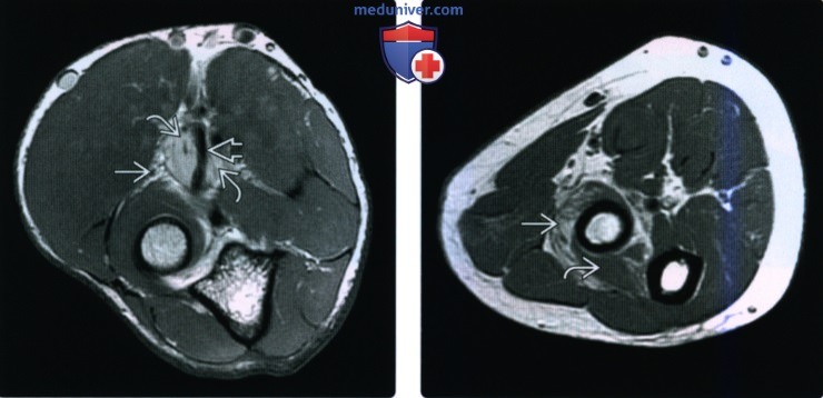 Рентгенограмма, КТ, МРТ при повреждении лучевого нерва