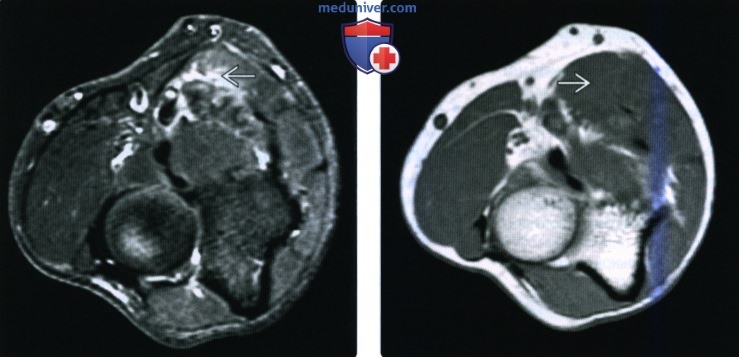 Рентгенограмма, КТ, МРТ при повреждении срединного нерва