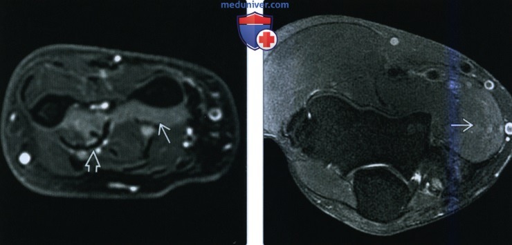 Рентгенограмма, КТ, МРТ при повреждении срединного нерва