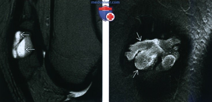 Рентгенограмма, КТ, МРТ при простой костной кисте