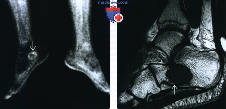 Рентгенограмма, КТ, МРТ при простой костной кисте