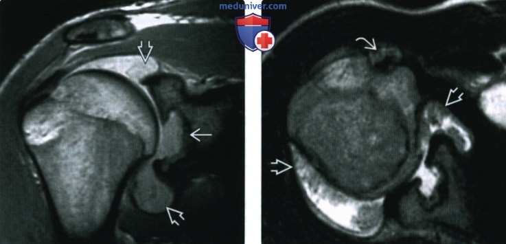 Рентгенограмма, КТ, МРТ при пигментном ворсинчато-узелковом синовите (ПВУС)