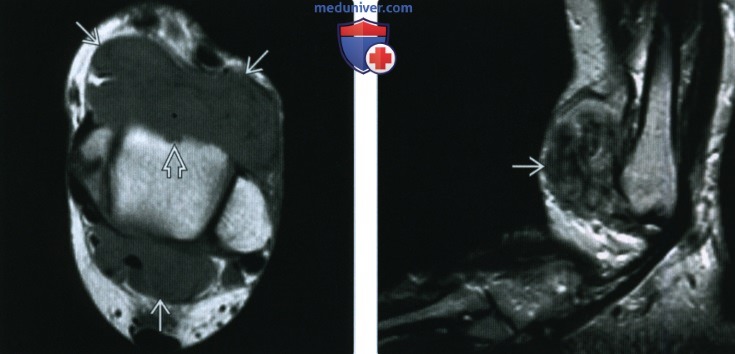 Рентгенограмма, КТ, МРТ при пигментном ворсинчато-узелковом синовите (ПВУС)