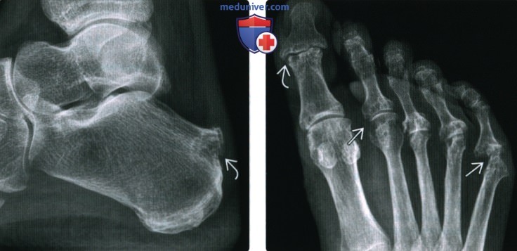 Рентгенограмма, КТ, МРТ при ревматоидном артрите голеностопного сустава и стопы