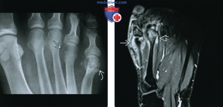 Рентгенограмма, КТ, МРТ при ревматоидном артрите голеностопного сустава и стопы
