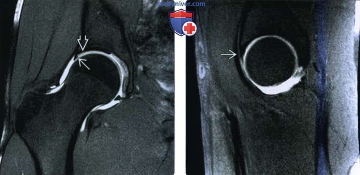 Рентгенограмма, КТ, МРТ при разрыве губы вертлужной впадины
