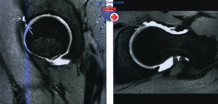 Рентгенограмма, КТ, МРТ при разрыве губы вертлужной впадины