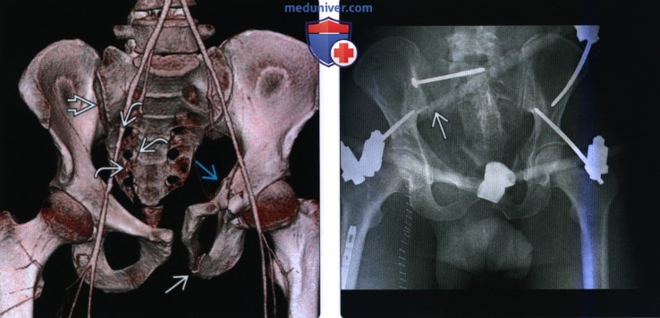 Рентгенограмма, КТ, МРТ при разрыве тазового кольца