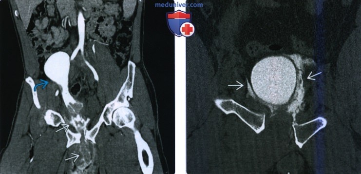 Рентгенограмма, КТ, МРТ при разрыве тазового кольца