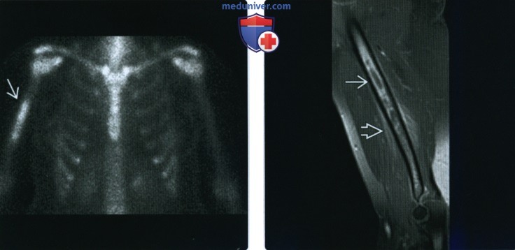 Рентгенограмма, КТ, МРТ при саркоме Юинга