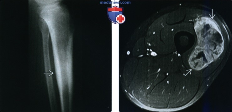 Рентгенограмма, КТ, МРТ при саркоме Юинга