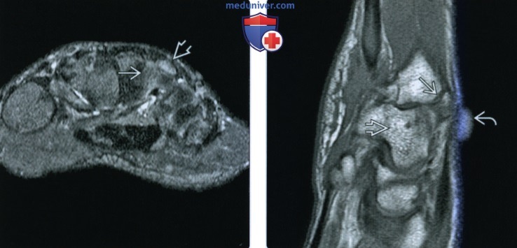 Рентгенограмма, КТ, МРТ при сесамовидных костях запясять и кисти