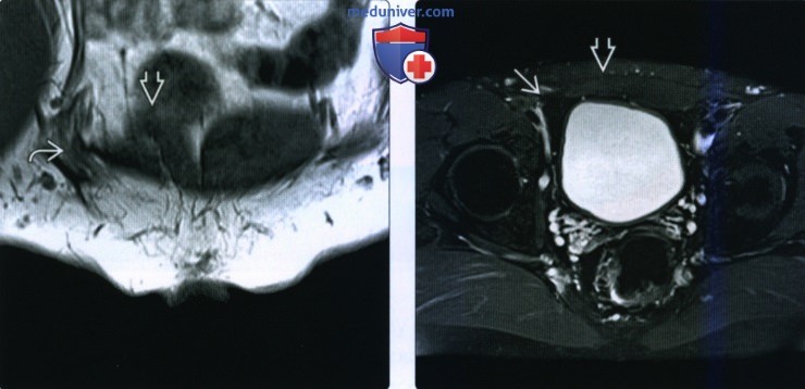 Рентгенограмма, КТ, МРТ при синдроме грушевидной мышцы и травмы нервов таза