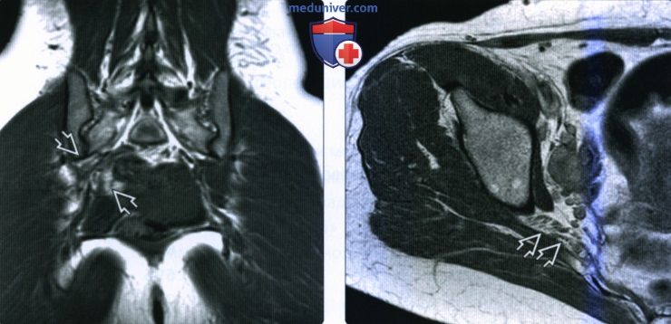 Рентгенограмма, КТ, МРТ при синдроме грушевидной мышцы и травмы нервов таза