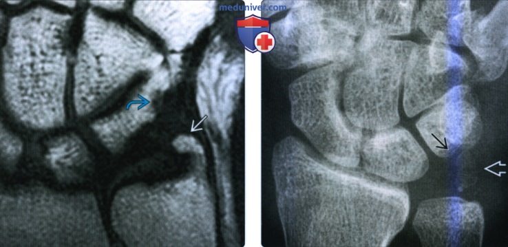 Рентгенограмма, КТ, МРТ при синдроме сдавливания запястья