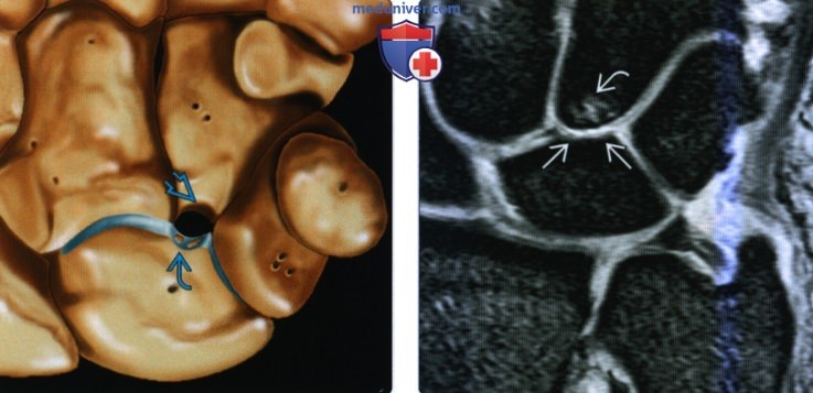 Рентгенограмма, КТ, МРТ при синдроме сдавливания запястья