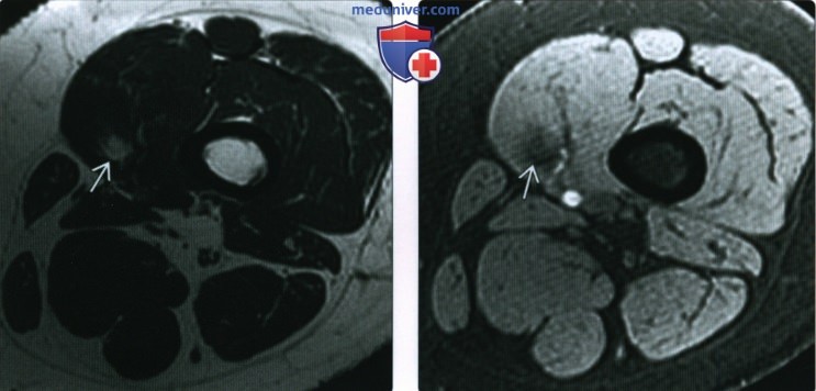 Рентгенограмма, КТ, МРТ при синовиальной саркоме