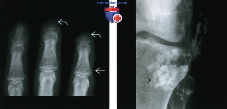 Рентгенограмма, КТ, МРТ при прогрессирующем системном склерозе