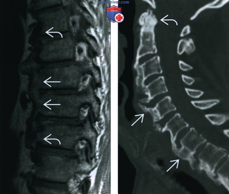 Рентгенограмма, КТ, МРТ при диффузном идиопатическом скелетном гиперостозе (ДИСГ)