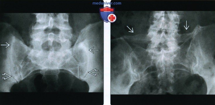 Рентгенограмма, КТ, МРТ при диффузном идиопатическом скелетном гиперостозе (ДИСГ)