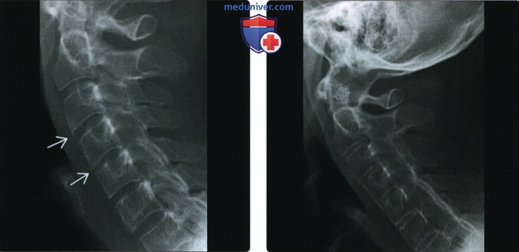 Рентгенограмма, КТ, МРТ при анкилозирующем спондилите