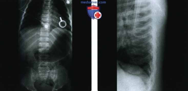 Рентгенограмма, КТ, МРТ при спондилоэпифизарной дисплазии