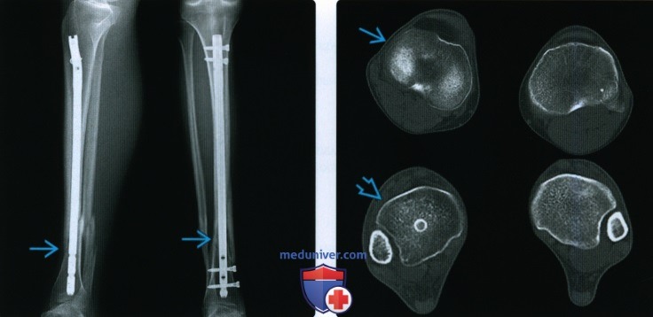 Рентгенограмма, КТ, МРТ при срастании перелома кости