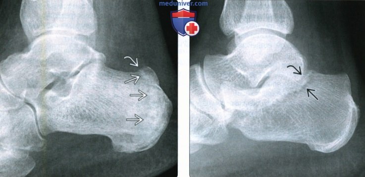 Рентгенограмма, КТ, МРТ при стресс-переломе костей голеностопного сустава и стопы