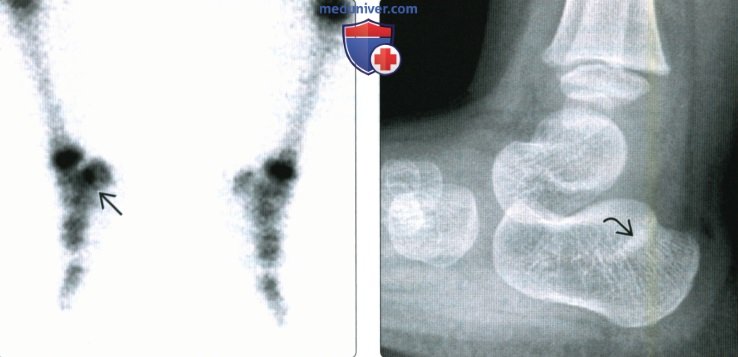 Рентгенограмма, КТ, МРТ при стресс-переломе костей голеностопного сустава и стопы
