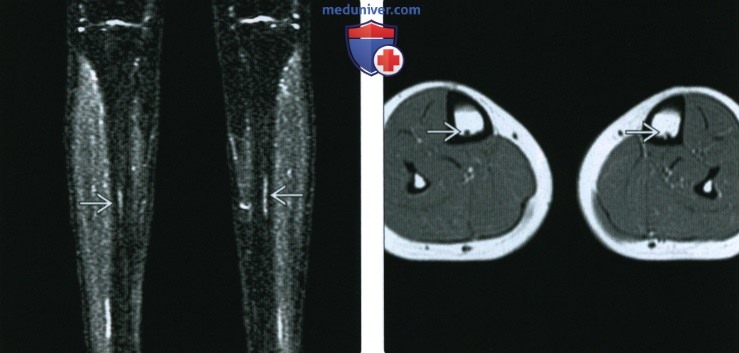 Рентгенограмма, КТ, МРТ при стрессовой травме голени