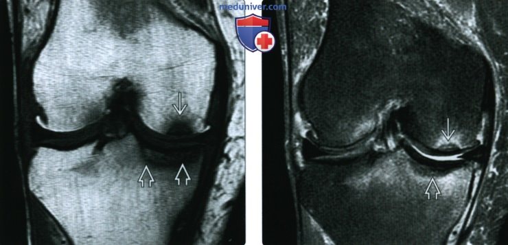 Рентгенограмма, КТ, МРТ при субхондральном переломе в коленном суставе